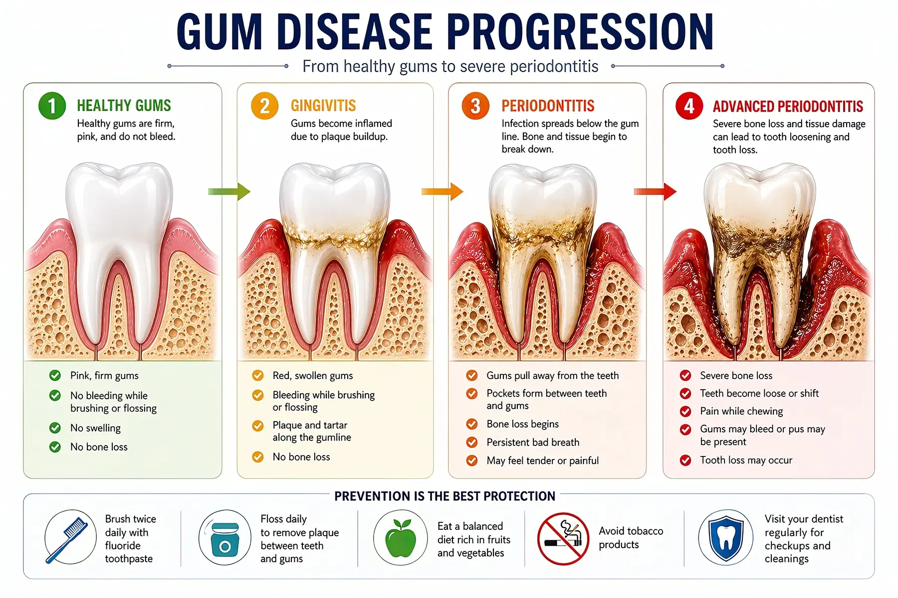 Image showing the stages of periodontal disease | Metropolitan Periodontists Minneapolis