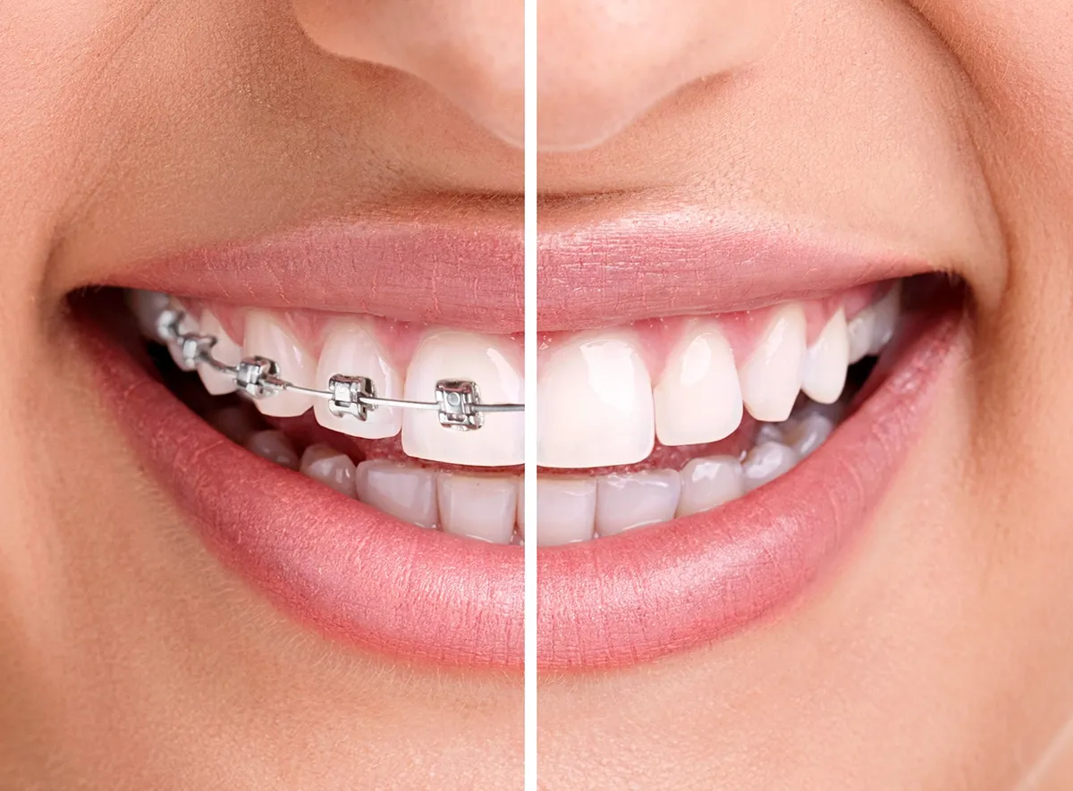 Before and after Wilckodontics treatment at Metropolitan Periodontists